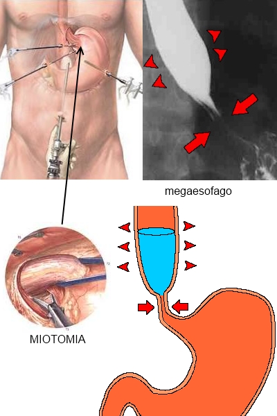 Acalasia-02