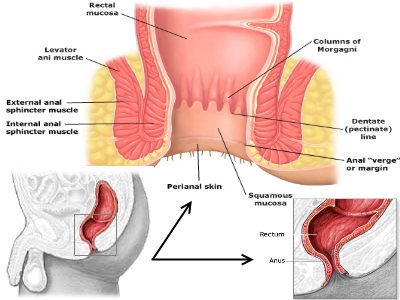 Cura rapida di emorroidi e incrinature