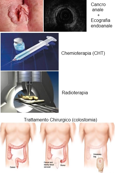 Cancerul anal - Tot ce trebuie să ştii | Cancer Tumore ano da hpv